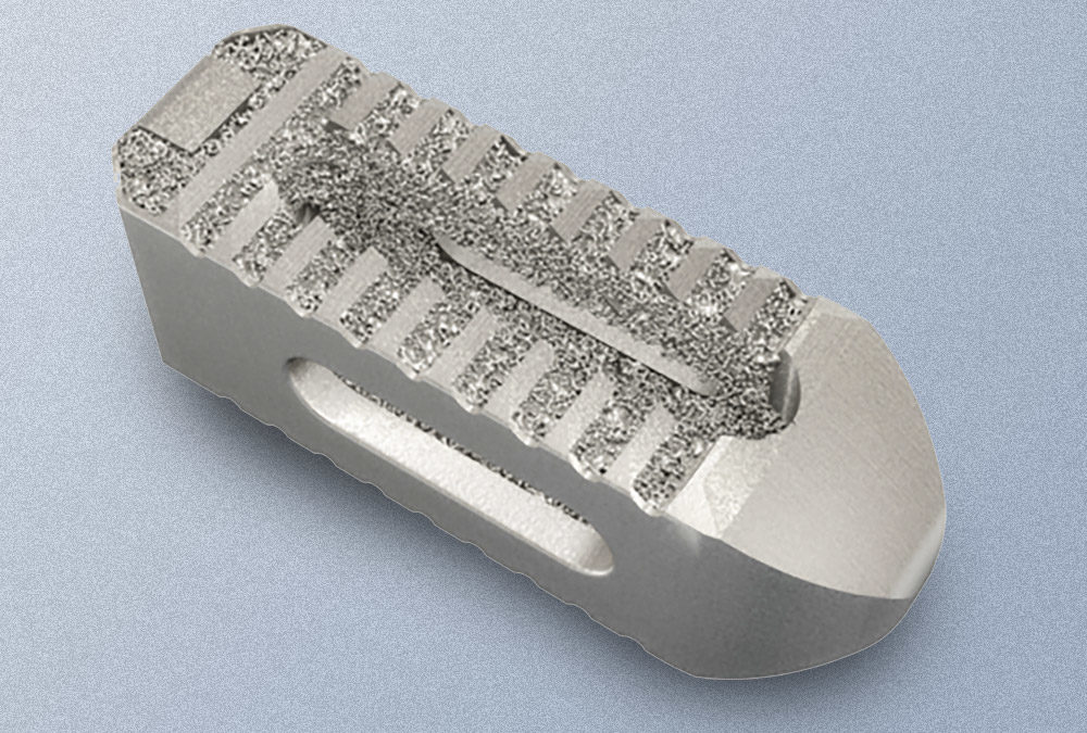 3D Spinal Implants and Ultrasonic Cleaning